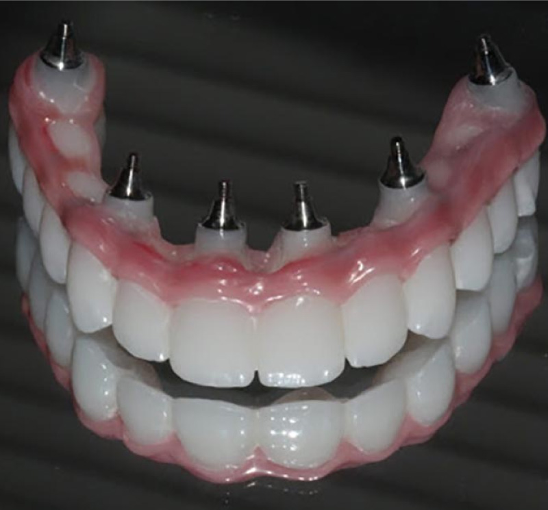 Immagine per servizio Implantologia fornito da Art Dental - Studio dentistico Pennacchio a Giugliano in Campania