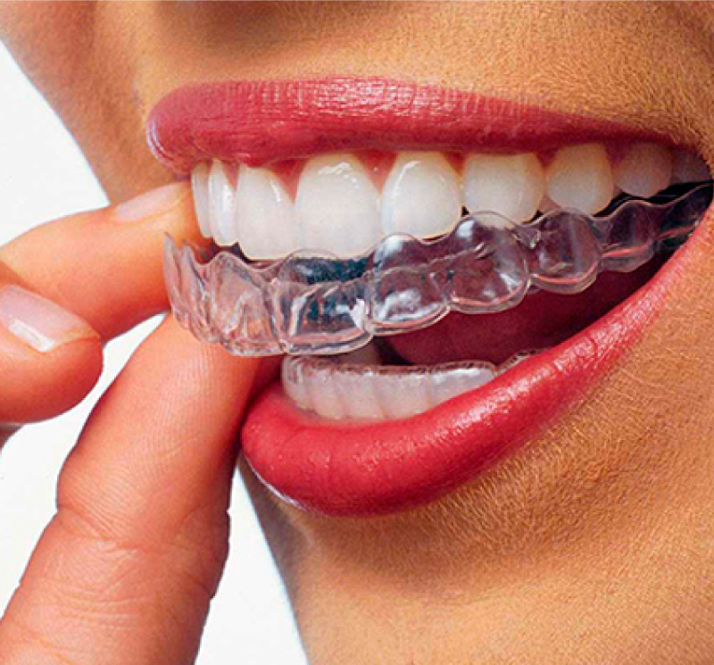 Immagine per servizio Provider ufficiale Invisalign fornito da Art Dental - Studio dentistico Pennacchio a Giugliano in Campania